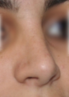 Après rhinoplastie ethnique